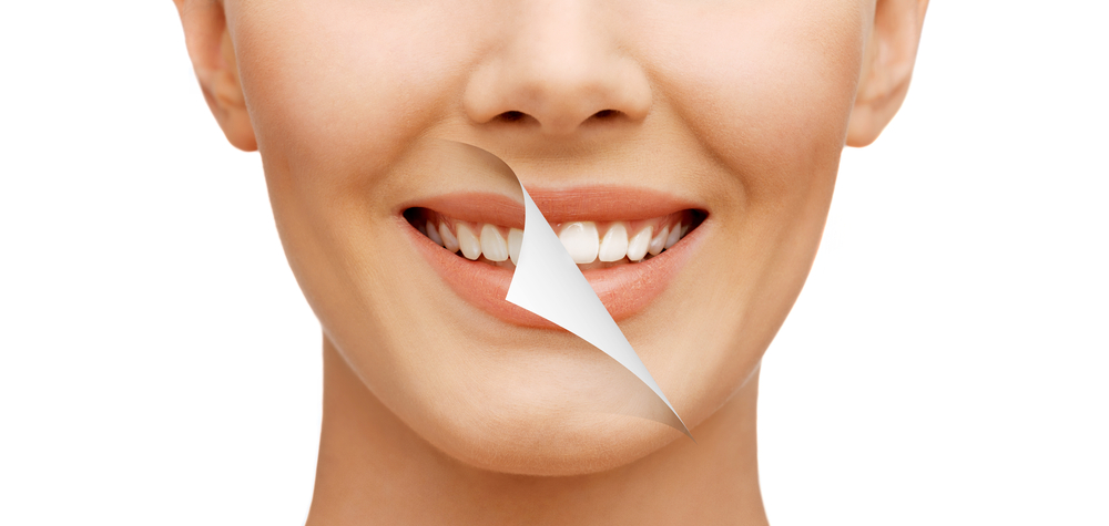 Teeth Whitening: Blanca d’ Orala Dentata