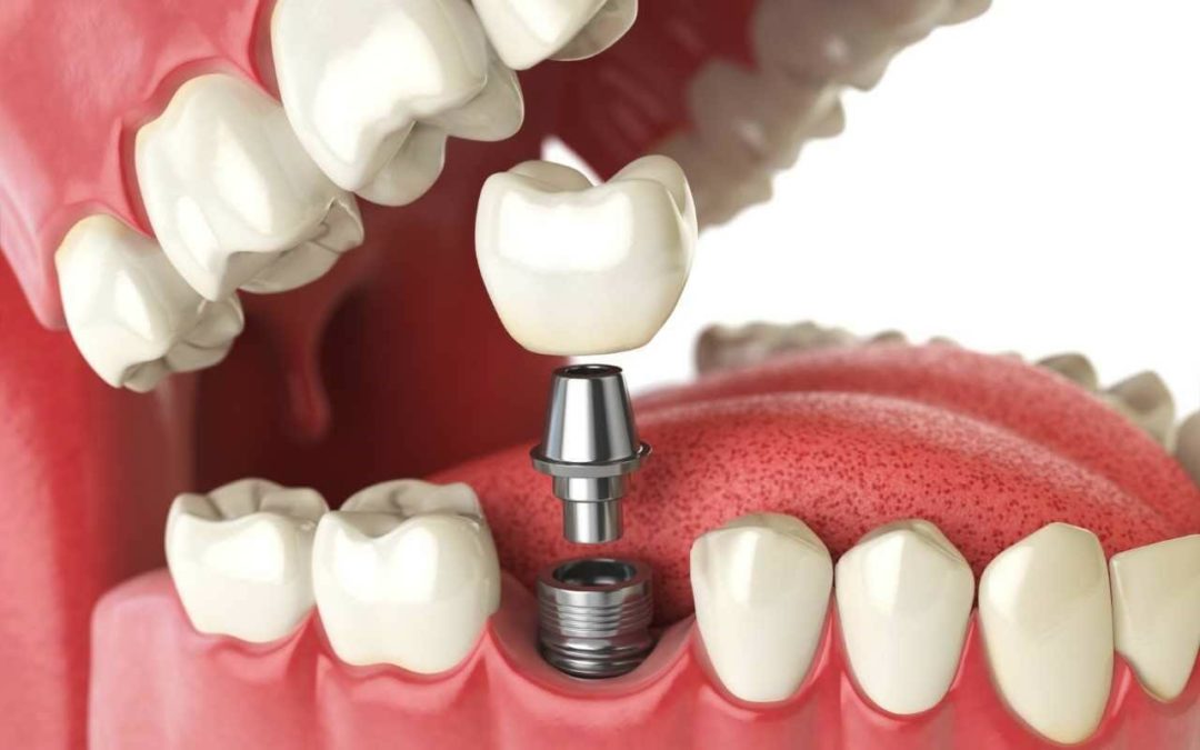 titanium dental implants