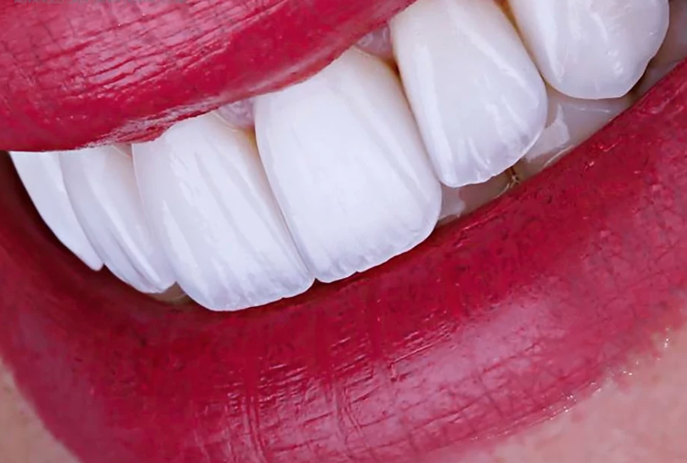Porcelain Veneers: Are They Better Than Other Dental Veneers?