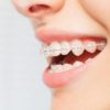 white teeth with metal braces