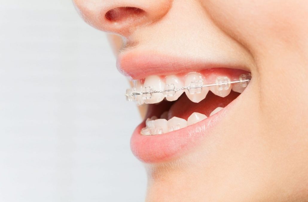 white teeth with metal braces