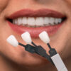 dental veneers